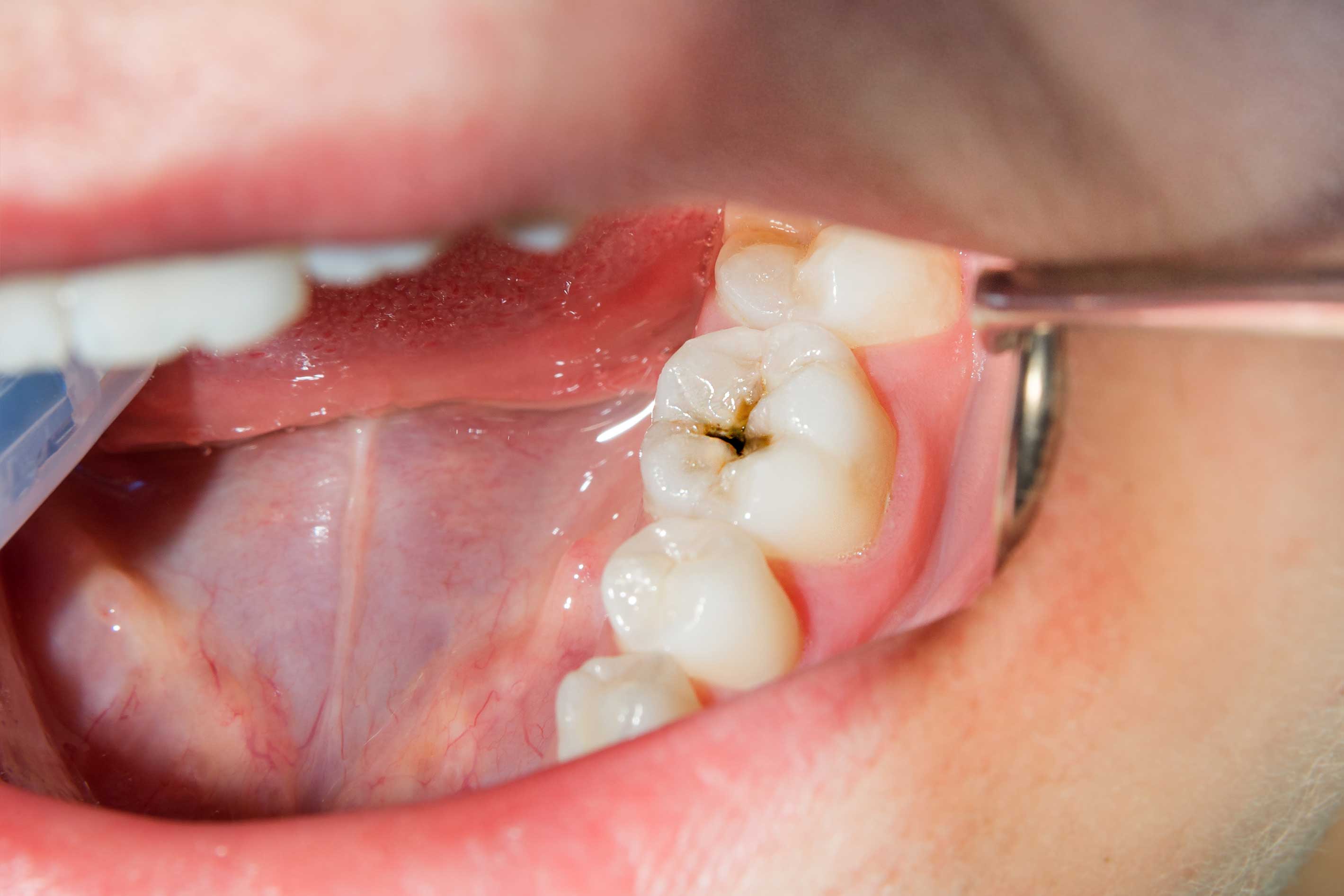 Close-up of a cavity on someone's tooth